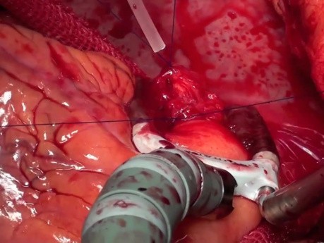 Full Arterial Off Pump Coronary Artery Bypass Grafting - 48 y.o. Male Patient