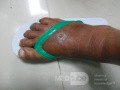 Diabetic Foot Ulcer - Edema - Non Medicated Shoes