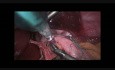 Nissen-Fundoplicatio
