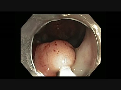 Colonoscopy - Snare resection - Back-hand Flip Technique - slow motion
