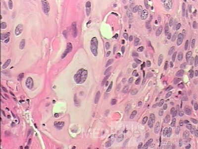 Perforation of a Esophageal Carcinoma after the procedure
 with hydrostatic balloon dilation (11 of 12)