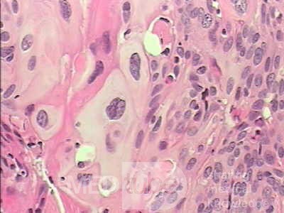 Perforation of a Esophageal Carcinoma after the procedure
 with hydrostatic balloon dilation (11 of 12)