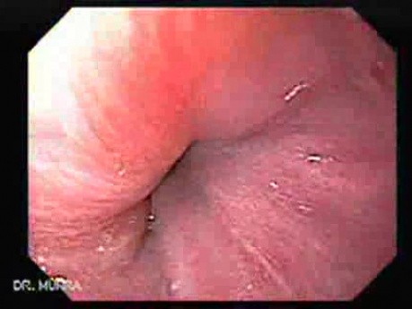 Linear Gastric Varices (1 of 3)