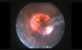 Endoscopic Transglottic Tumour Excision 2