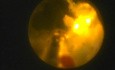 Greenlight HPS Prostatectomy