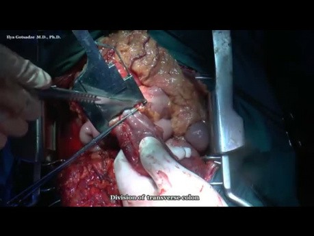 Right Complete Mesocolic Excision for Locally Advanced Right Colon Cancer with D3 Lymphadenectomy