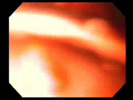 Bleeding Due to Dieulafoy´s Lesion (5 of 8)