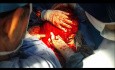 Huge Soft Tissue Tumor