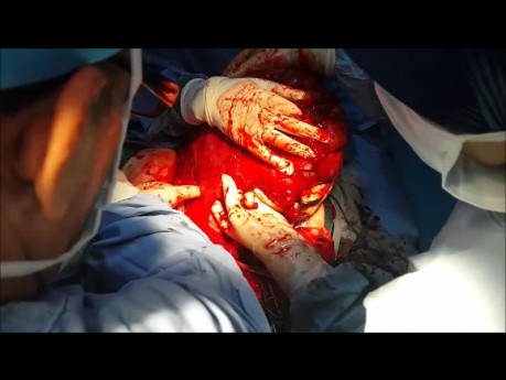 Huge Soft Tissue Tumor