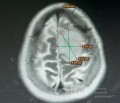 Surgical Planning with Neuronavigator in Patient with Intracranial Mass Lesion. High Grade Glioma.