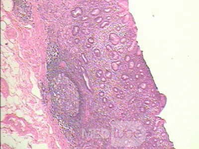Early Gastric Cancer (17 of 21)