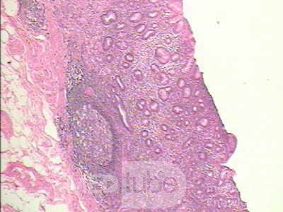 Early Gastric Cancer (17 of 21)