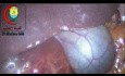 Huge Liver Cyst is Best Managed with Laparoscopy