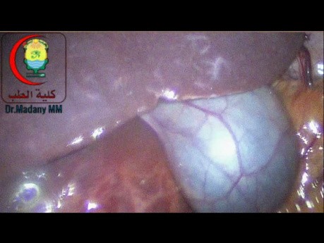 Huge Liver Cyst is Best Managed with Laparoscopy