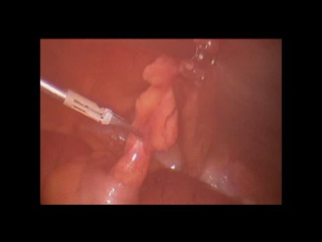Laparoscopic Relief of Small Bowel Obstrcution