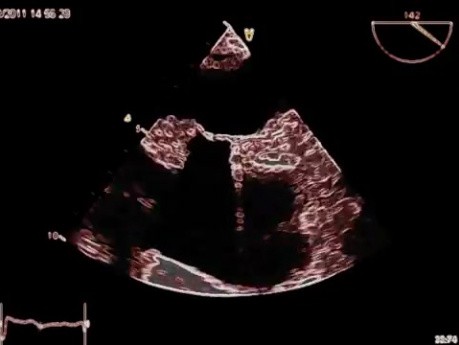 Lipomatous Hypertrophy of the Atrial Septum (LHAS) - Video nr 1