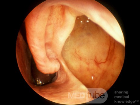 Large Inferior Meatal Antrostomy