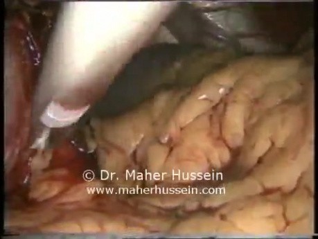 Redo Nissen Fundoplication - Laparoscopy