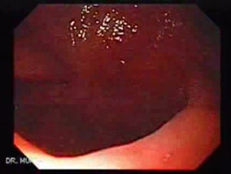 Colonic Interposition for Esophageal Substitution (5 of 11)