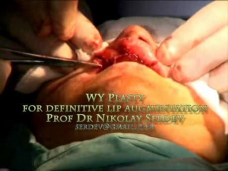 WY-Plasty