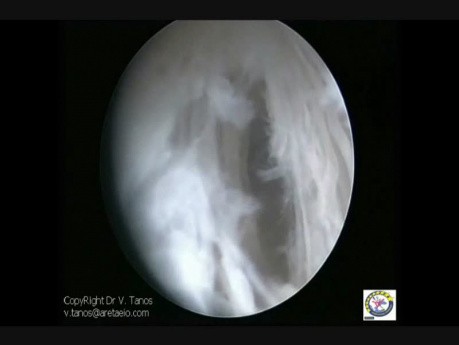 Intrauterine Adhesions - Asherman's Syndrome 