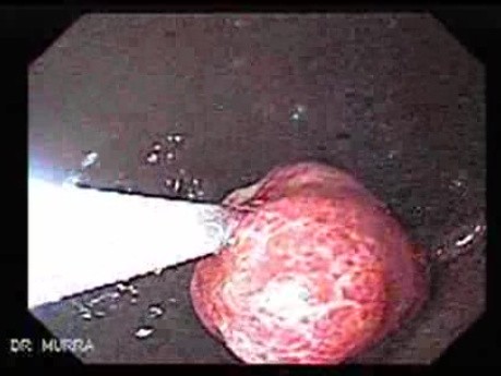 Gastric Polyposis - Endoscopy (6 of 11)