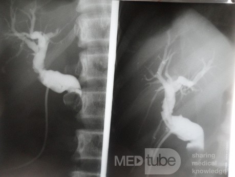 T-tube cholangiography show missed stone in the common bile duct