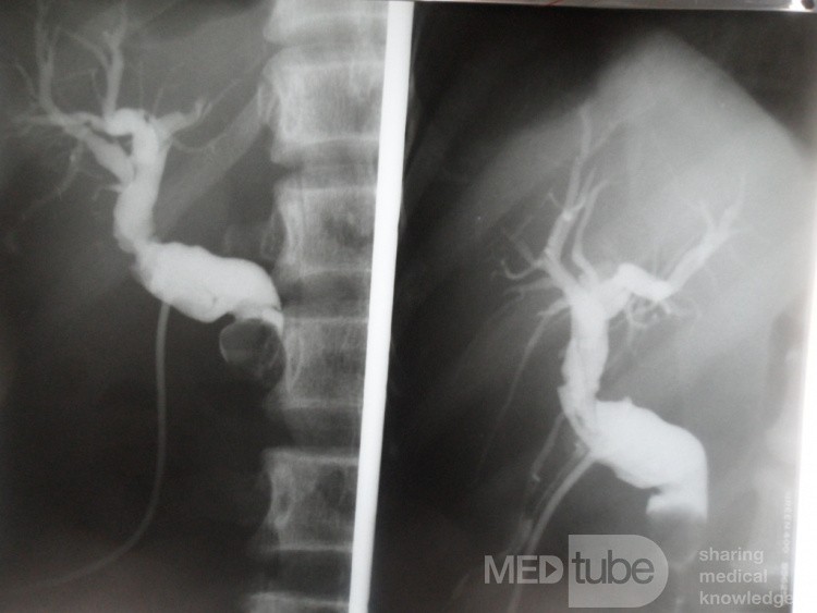 T-tube cholangiography show missed stone in the common bile duct