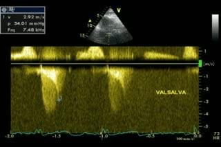Hcm + Aortic Stenosis