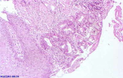 Barrett's Ulcer (3 of 5 )
