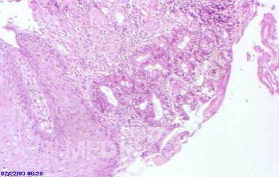 Barrett's Ulcer (3 of 5 )