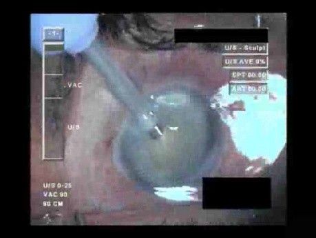 Cataract Surgery I - 1