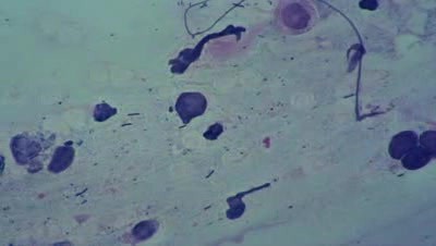Cervical canal - Cytological examination - 2