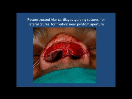Revision Nasal Tip Plasty in a Thick Skin Patient 