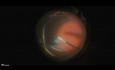 Phacovitrectomy in Retinal Detachment (3D)