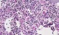 Gaucher disease - Histopathology of spleen 