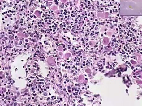 Gaucher disease - Histopathology of spleen 