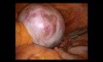 Ovarian Teratoma Anexectomy
