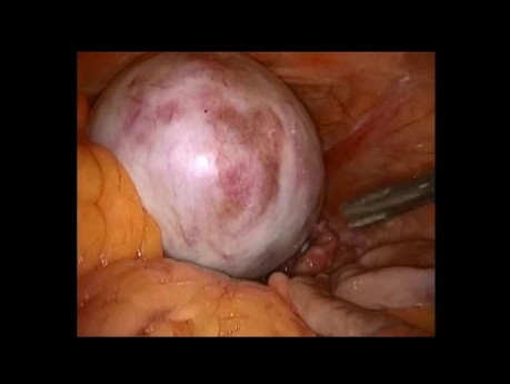 Ovarian Teratoma Anexectomy
