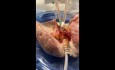 Is Rib Trauma Contraindication for Lung Procurement? 