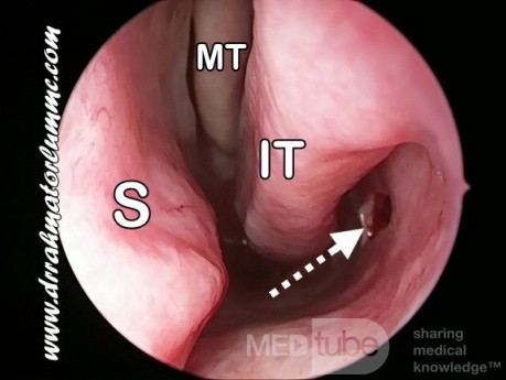 Inferior Antrostomy Made By Coakley Trocar 