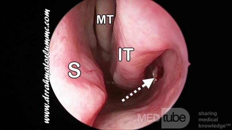 Inferior Antrostomy Made By Coakley Trocar 