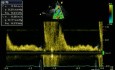 Reverse Diastolic Flow - Descending Aorta