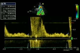 Reverse Diastolic Flow - Descending Aorta