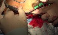 Cranial Vault, Zygoma and Maxillary Fractures Surgical Treatment