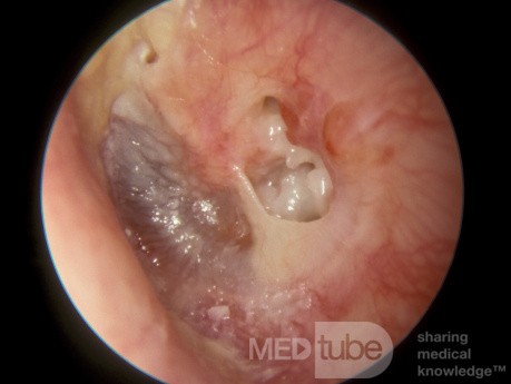 Peripheral Tympanic Membrane Perforation with Cholesteatoma