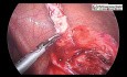 Laparoscopic Management of Retrocecal Ruptured Appendix