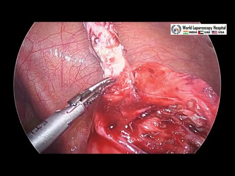 Laparoscopic Management of Retrocecal Ruptured Appendix