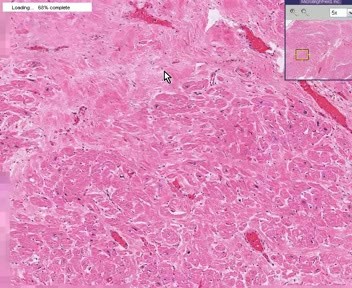 Myocardial Infarct - Remote