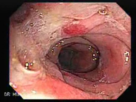 Diverticular Colitis (4 of 7)